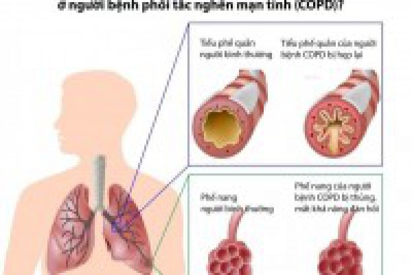 Bài thuốc quý từ thảo dược cho người bị hen suyễn, COPD